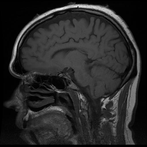 olfactory fibers visible descending from olfactory cortex in the cerebrum into the nasal sinus. Sagittal plane MRI image